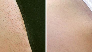 Laser hair removal before and after photos