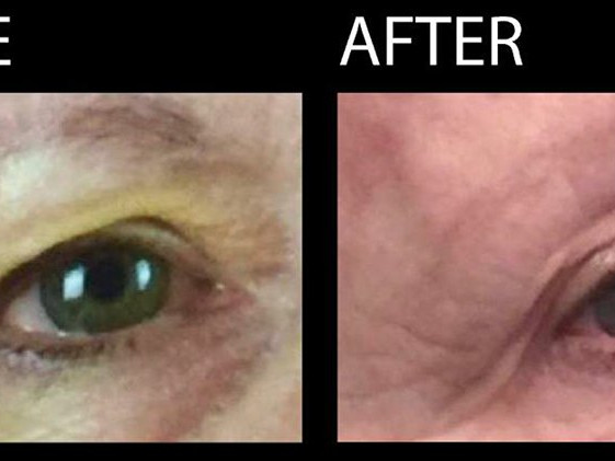 PDO Eye Thread Before and After photos