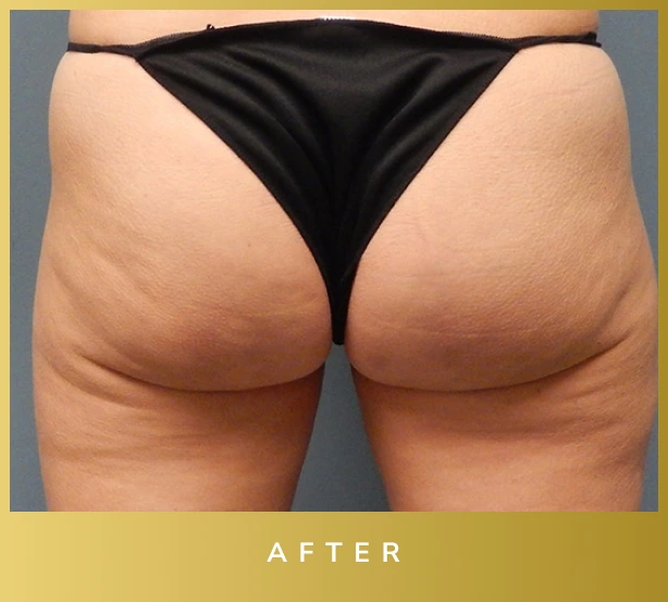 Avéli Cellulite Treatment Before and After Banner