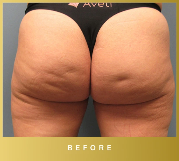 Avéli Cellulite Treatment Before and After