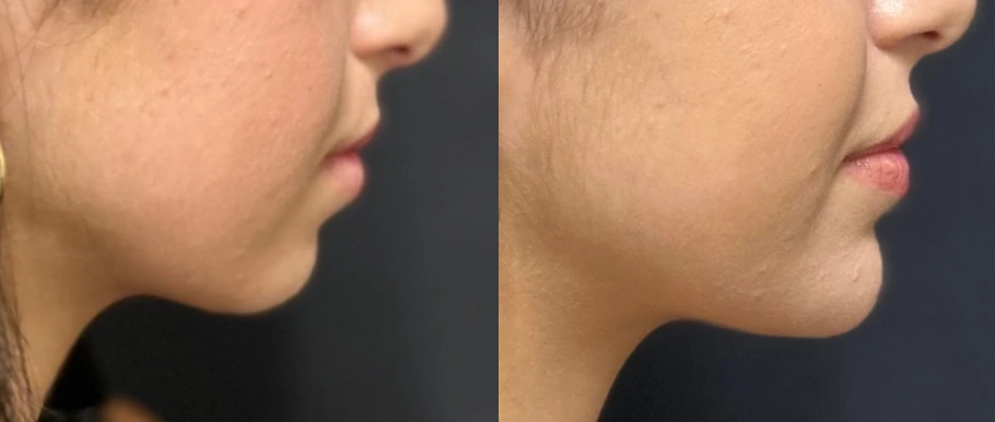 Before & After Chin Augmentation With Fillers Banner